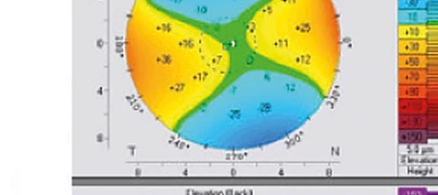 Mappa corneale Pentacam OD — elevazione anteriore