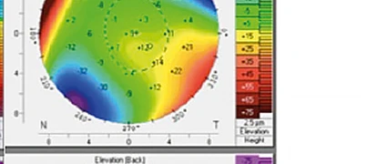 Mappa corneale Pentacam OS — elevazione anteriore