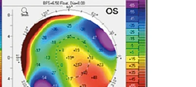 Mappa corneale Pentacam OS — elevazione posteriore