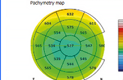 Pachymetry Map OD